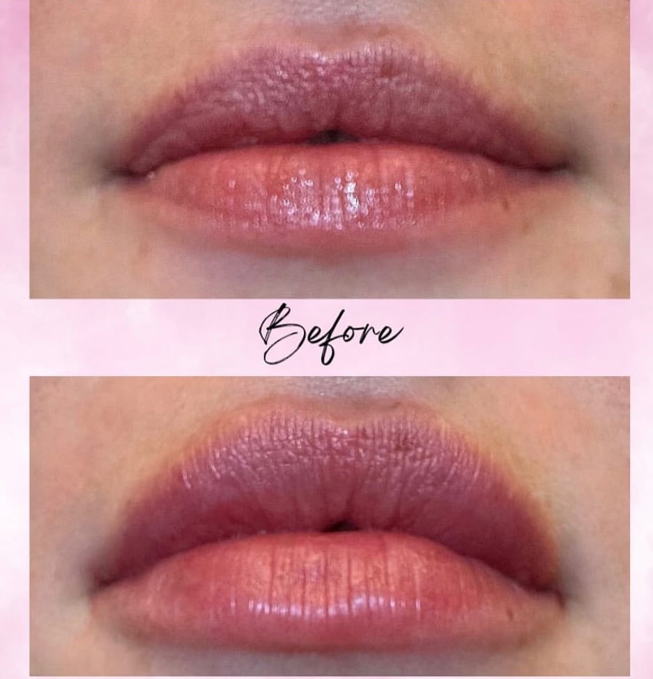 Lips before and after lip filler rehabilitation