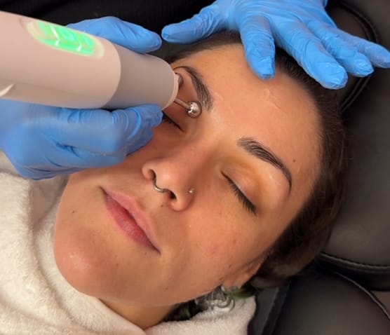 Radio frequency skin tightening treatment on a client's face